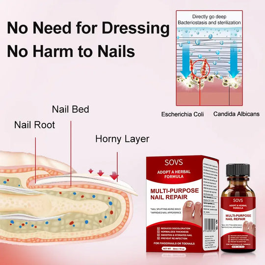 SOVS Toenail Fungus Treatment Extra Strength ,Antifungal Solution ,Triple Action Formula for Damaged Nails, Multi-Purpose Nail Repair,1 Fl Oz Manicure Therapy💅🏻