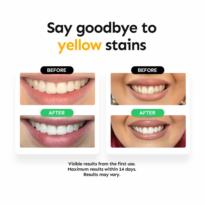 Whiter Smile, Zero Sensitivity — The Professional Non-Peroxide Whitening Secret
