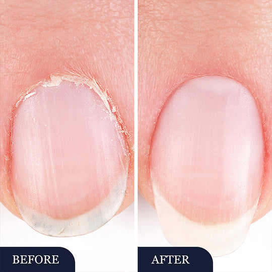 Toenail Fungus Treatment Pen for Damaged Nails
